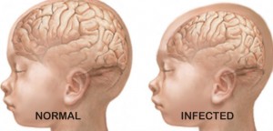 Zika-Virus-Baby-banner