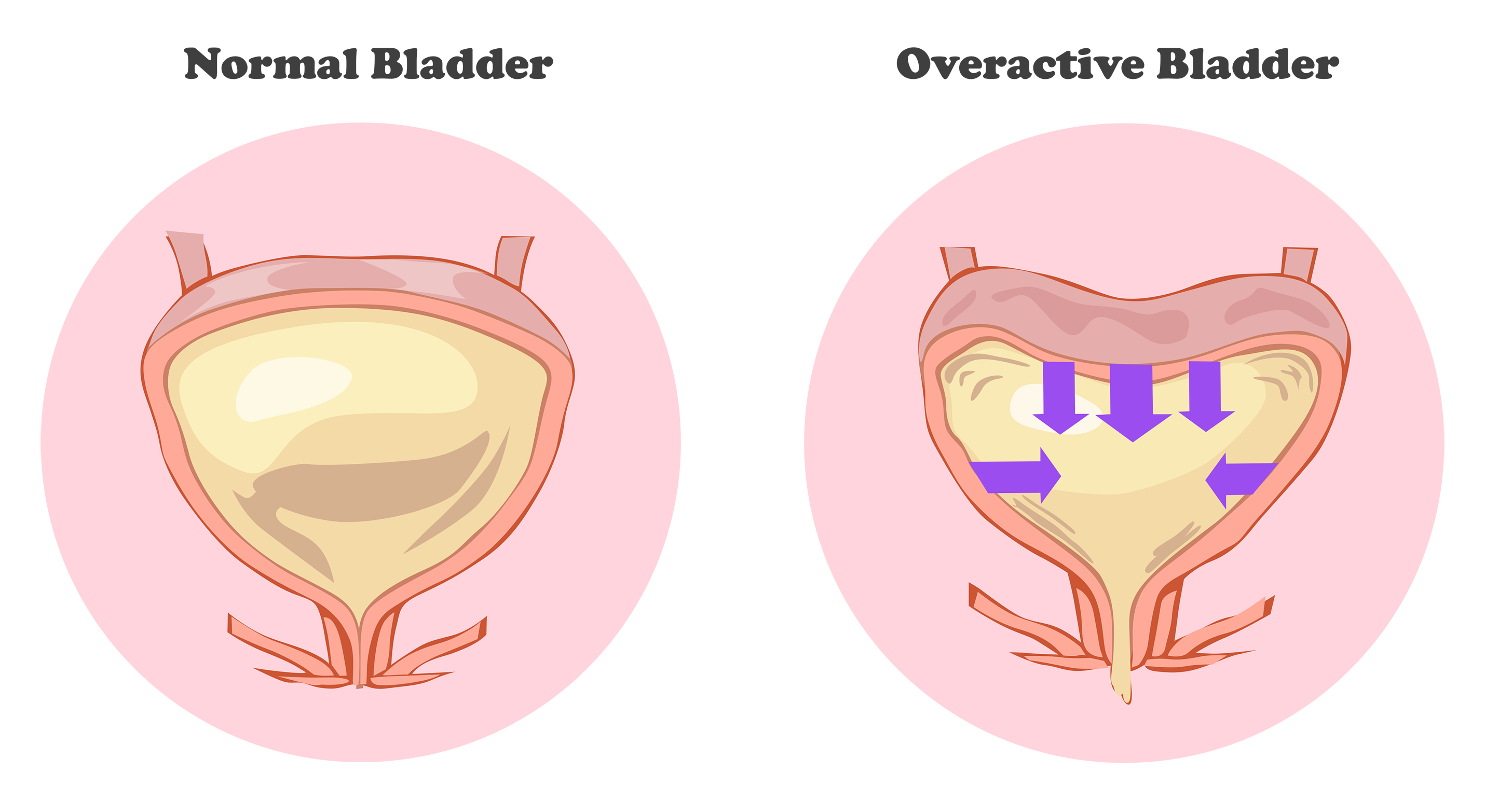 wandering bladder