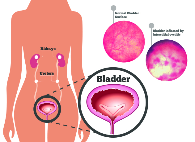 What is Interstitial Cystitis(IC)/Bladder Pain Syndrome? - Urology Care  Foundation